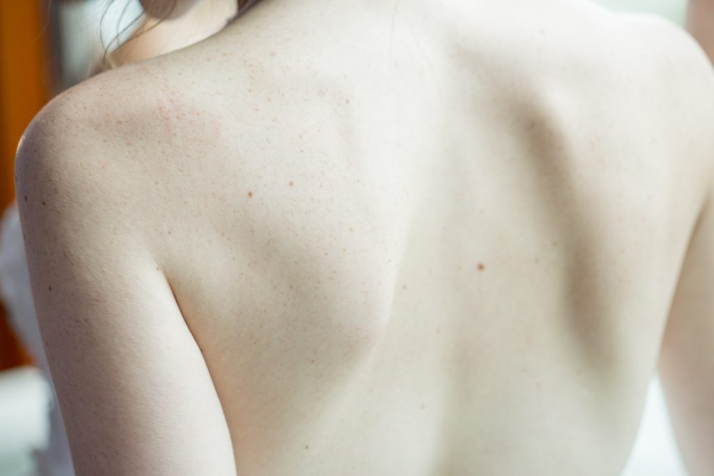 Nackter Rücken mit Leberflecken. Im Artikel: Die unsichtbare Gefahr für die Haut