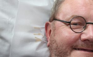 Ein lachender Mann mit runder Brille und Vollbart hat mehrere kleine Akupunktur-Nadeln im Ohr