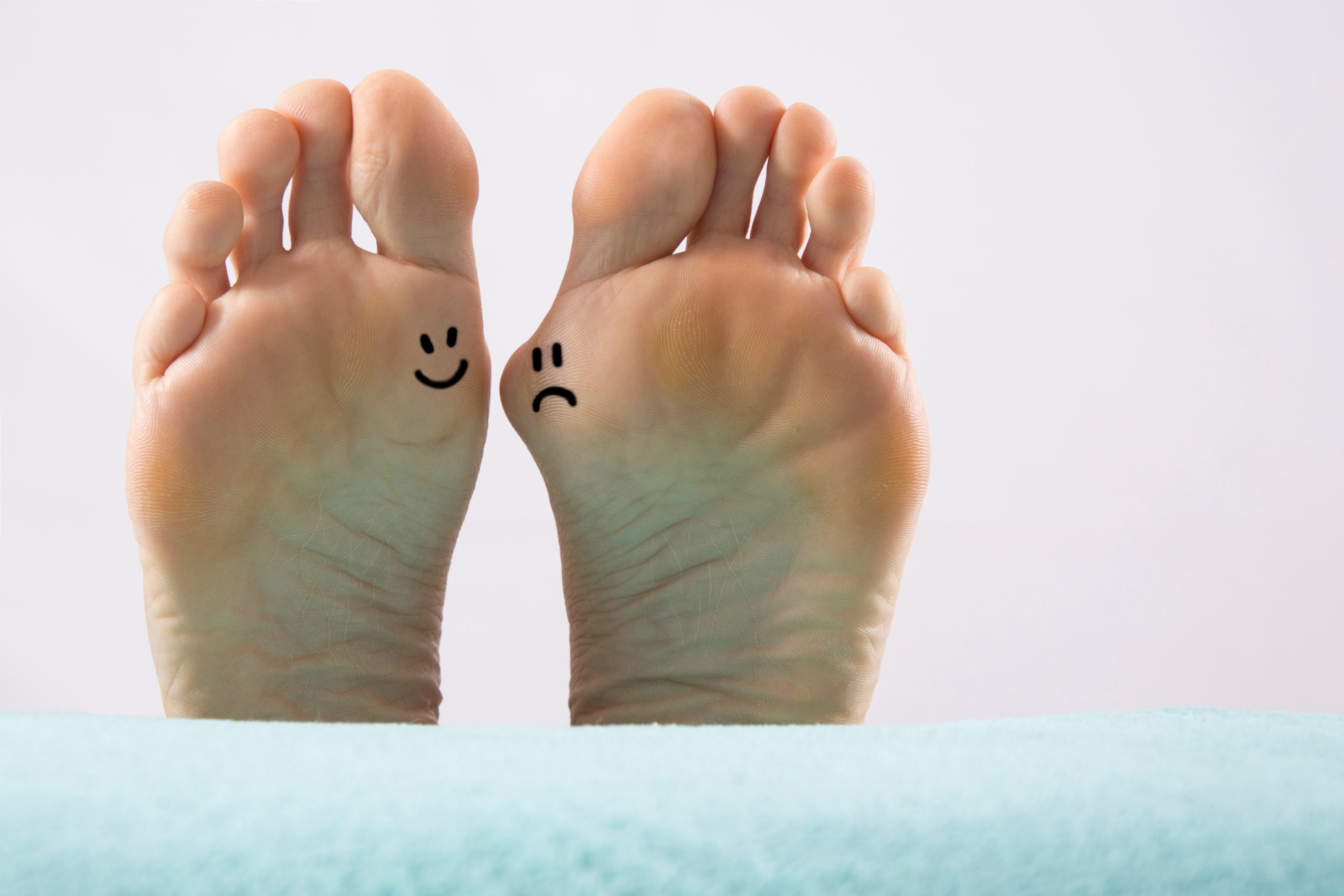 Zwei Füße nebeneinander: Links ein gesunder auf dem mit schwarzem Filzstift ein lachendes Gesicht aufgemalt ist - rechts ein Fuß mit einer Beule, dem Hallux valgus